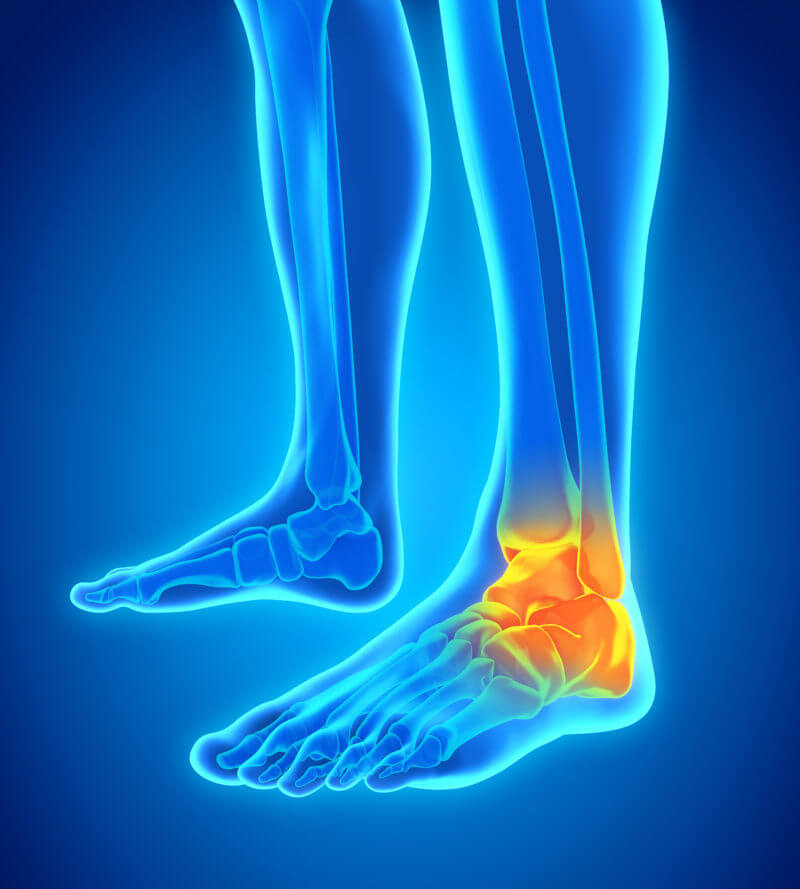 Stress Fracture Of The Talus - Ankle - Conditions - Musculoskeletal - What  We Treat 