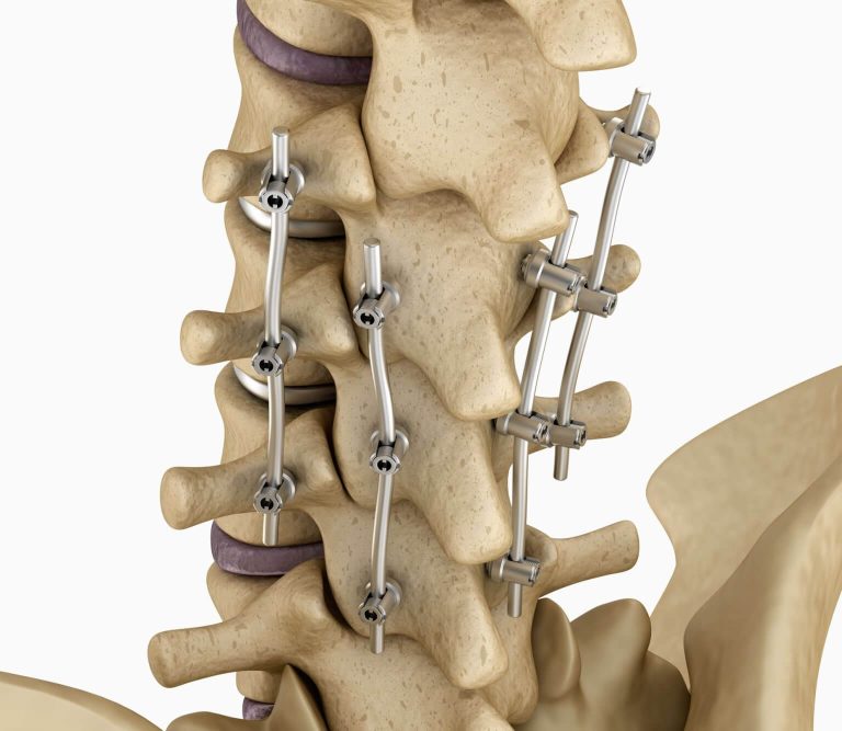 Spinal Fusion Spine And Orthopedic Specialists Neo Surgical Group 7790