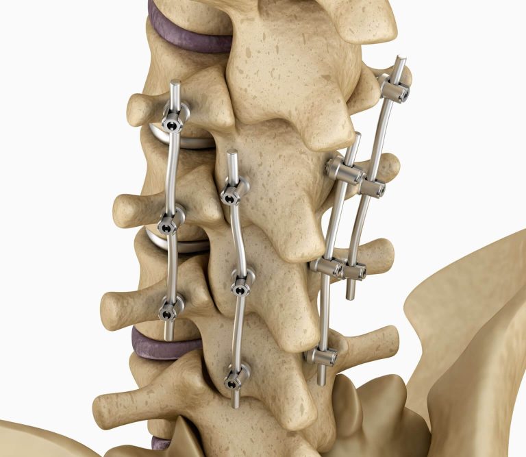 Spinal Fusion Spine and Orthopedic Specialists NEO Surgical Group